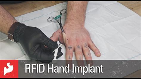 rfid implant for hand